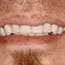 Removable Denture Before and After - Andover Family Dentistry Smile Gallery