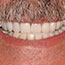Complete Smile Reconstruction - Andover Family Dentistry Smile Gallery