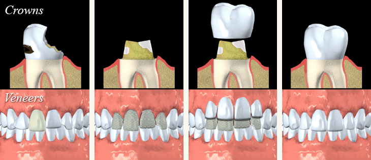 Porcelain Crowns and Veneers - Andover Family Dentistry