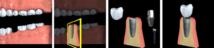 Dental Implants - Andover Family Dentistry
