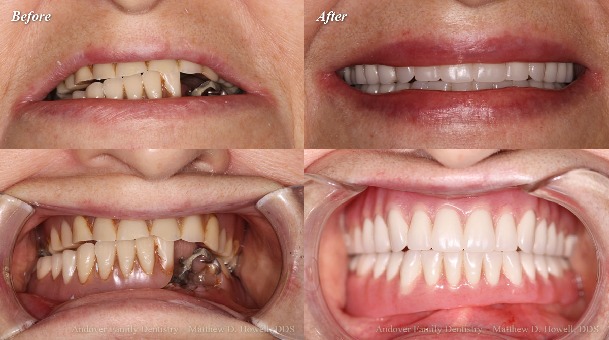 Smile Gallery Wichita Dental Andover Family Dentistry