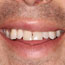 Bonding Before and After - Andover Family Dentistry Smile Gallery