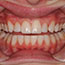 Composite Veneers Before and After - Andover Family Dentistry Smile Gallery