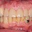 Smile Reconstruction � Using Porcelain Crowns and a Removable Partial Denture - Andover Family Dentistry Smile Gallery