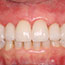 Smile Makeover Using Porcelain Crowns - Andover Family Dentistry Smile Gallery