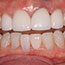 Replacement of Old Crowns and Professional Whitening - Andover Family Dentistry Smile Gallery