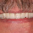 Replacement of Old Dentures - Andover Family Dentistry Smile Gallery