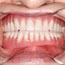 Dentures Before and After - Andover Family Dentistry Smile Gallery