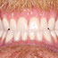 Teeth Replacement Using Dentures - Andover Family Dentistry Smile Gallery