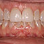 Replacement of Mismatched Porcelain Crowns - Andover Family Dentistry Smile Gallery