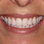 Replacement of Mismatched Porcelain Veneers - Andover Family Dentistry Smile Gallery