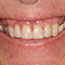 One Visit Composite Veneers on Top teeth and a Removable Partial Denture on Lower teeth - Andover Family Dentistry Smile Gallery