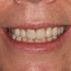 Porcelain Crowns Before and After - Andover Family Dentistry Smile Gallery