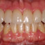 Porcelain Crowns - Andover Family Dentistry Smile Gallery