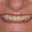 Porcelain Veneers Before and After - Andover Family Dentistry Smile Gallery