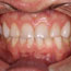 One Visit Composite Veneers Before and After - Andover Family Dentistry Smile Gallery