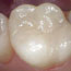 Silver Filling and Composite Restoration Before and After - Andover Family Dentistry Smile Gallery