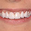 Smile Makeover - Andover Family Dentistry Smile Gallery