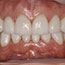Porcelain Veneers and Crowns Before and After - Andover Family Dentistry Smile Gallery
