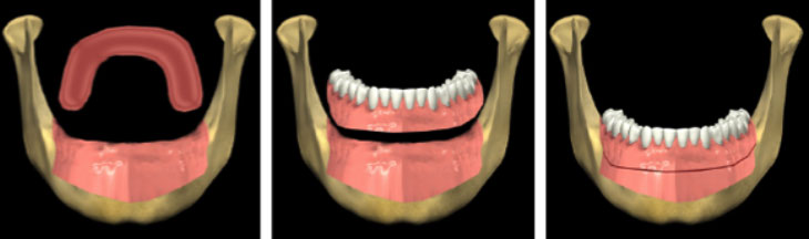 Complete Dentures - Andover Family Dentistry