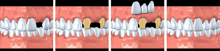 Dental Bridges - Andover Family Dentistry