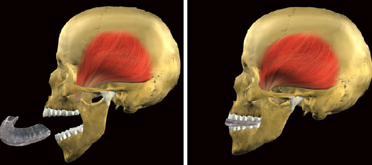 Dental Nightguards and Splints - Andover Family Dentistry