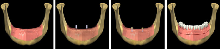 Implant-Supported Dentures - Andover Family Dentistry