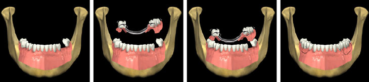 Partial Dentures - Andover Family Dentistry