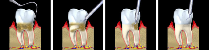 Periodontal Treatment - Andover Family Dentistry