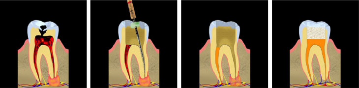 Root Canal Therapy - Andover Family Dentistry